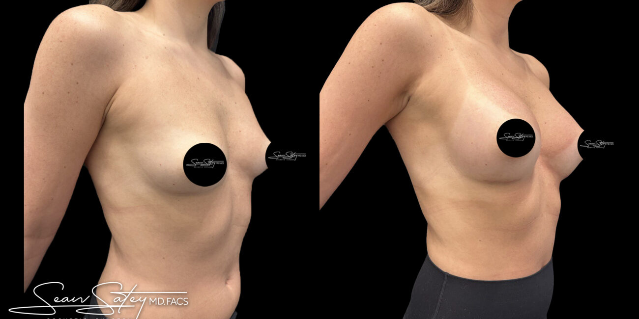Augmentation