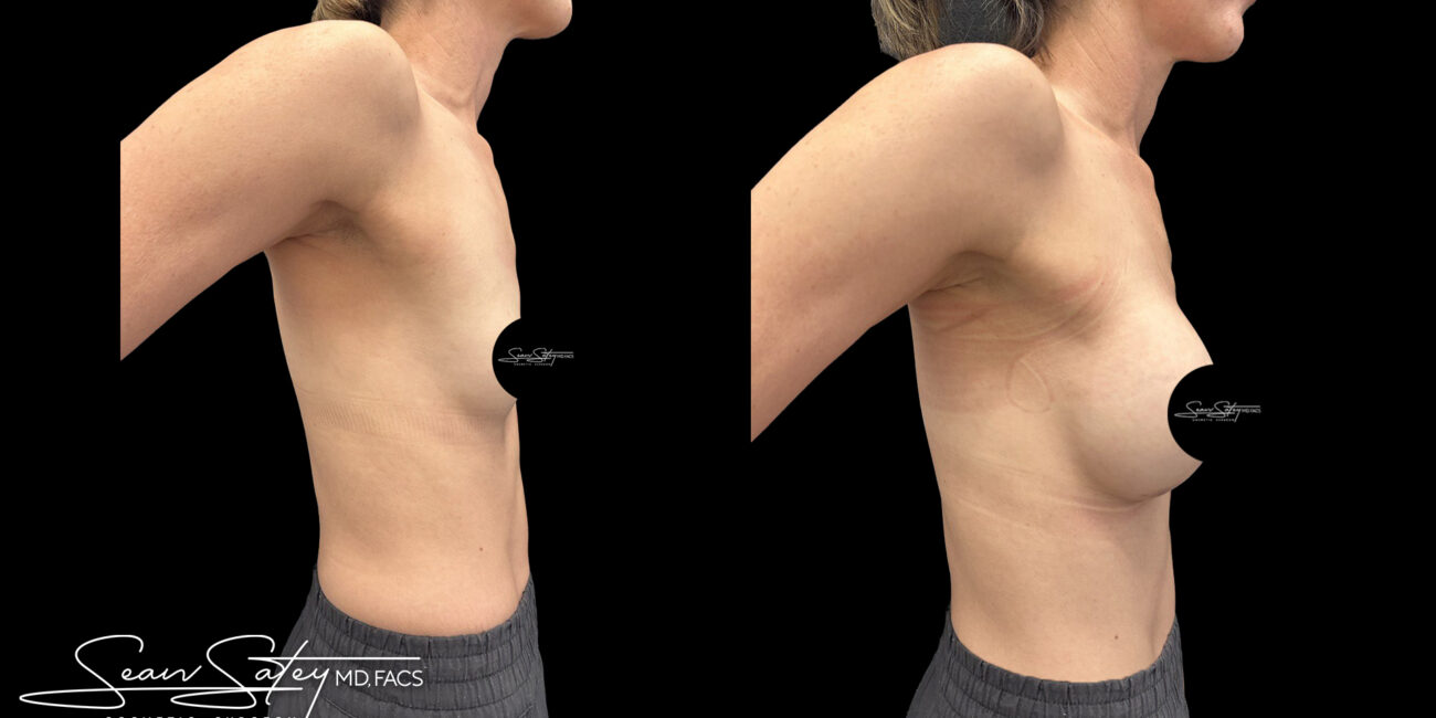 Bilateral silicone implants - dr sean satey (1)