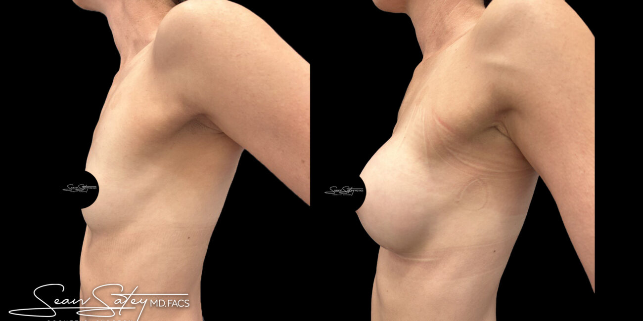 Bilateral silicone implants - dr sean satey (3)