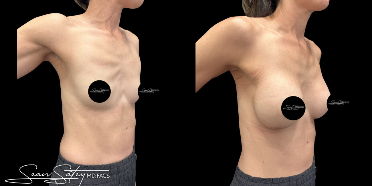 Bilateral silicone implants - dr sean satey (4)