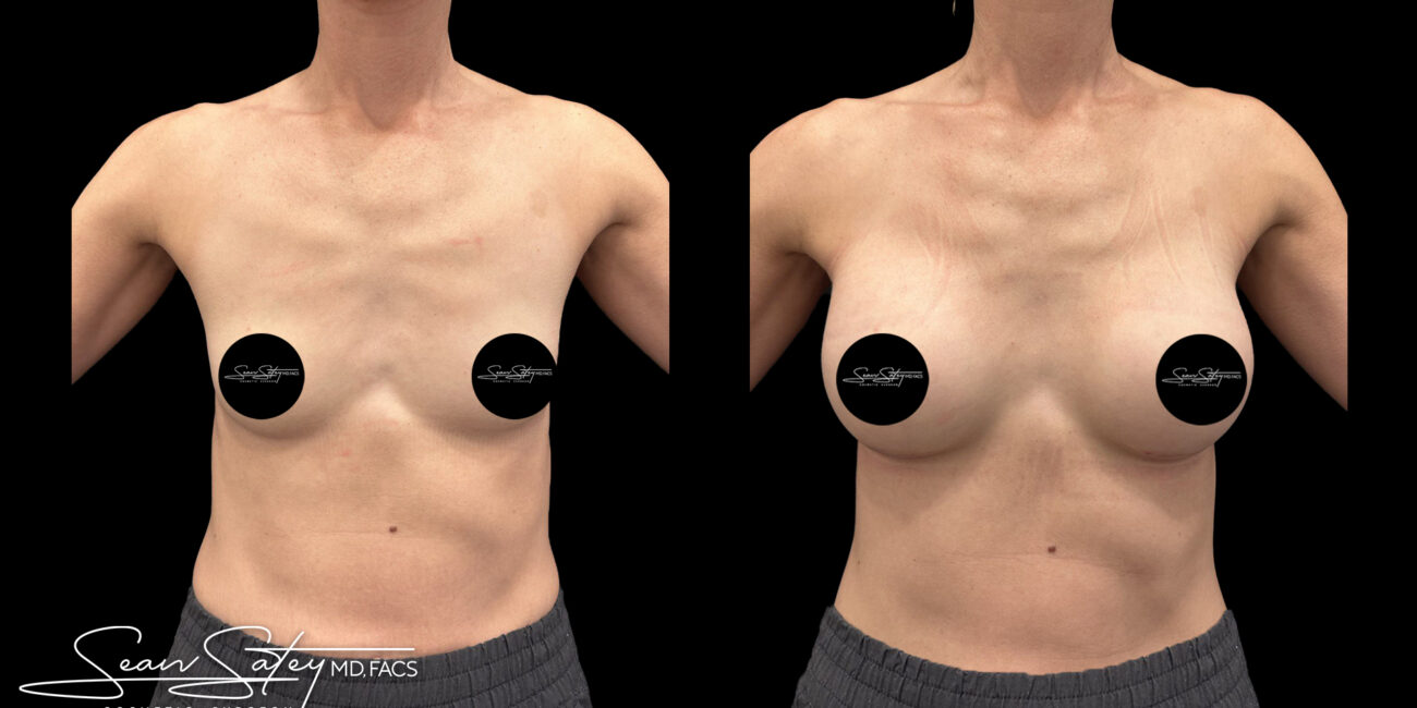 Bilateral silicone implants - dr sean satey (5)