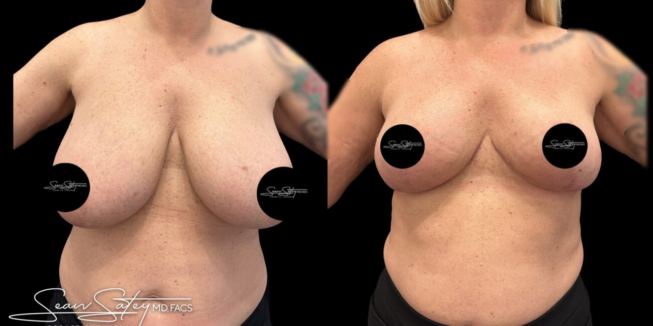 reduction-of-breast-and-lift (1)